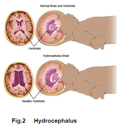 Image of normal brain and ventricals and brain and ventricals with hydrocephalus