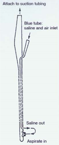 Diagram showing how Replogle tube works