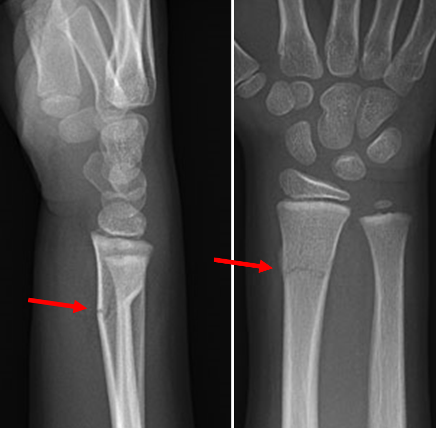 greenstick fracture x ray