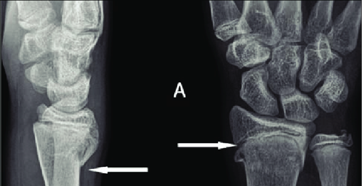 acute buckle fracture wrist