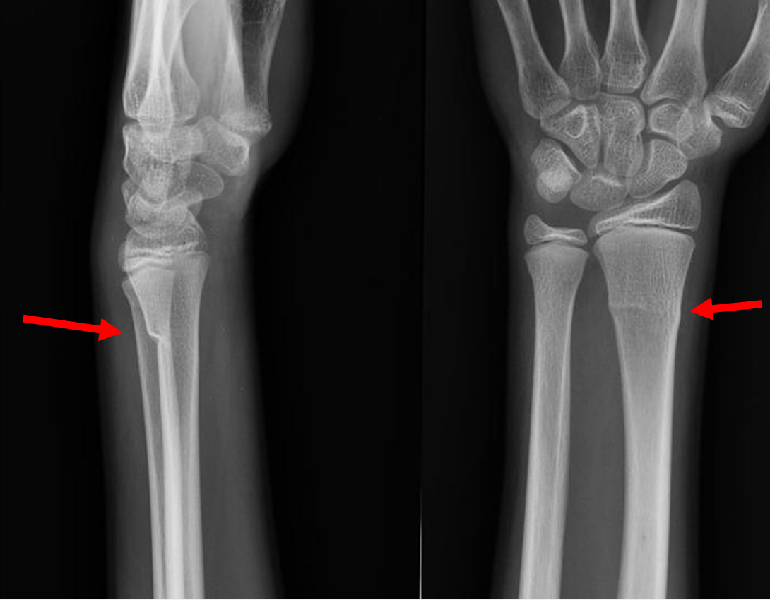 buckle fracture wrist 2 year old