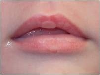 Image of sucking blister on an infant's lip