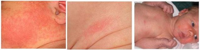 Images of Erythema Toxicum in an infant